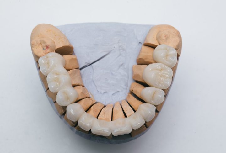 Dental Bridges 1