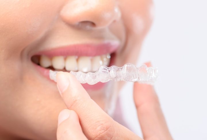 Straightening Teeth with Clear Aligners